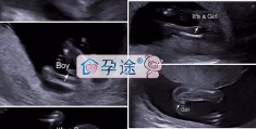 四年备孕之路，多囊患者试管婴儿一次成功经验分享！ 