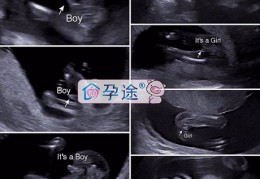 四年备孕之路，多囊患者试管婴儿一次成功经验分享！ 