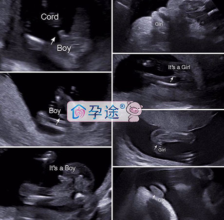 老公重度弱精，试管婴儿助孕一次成功